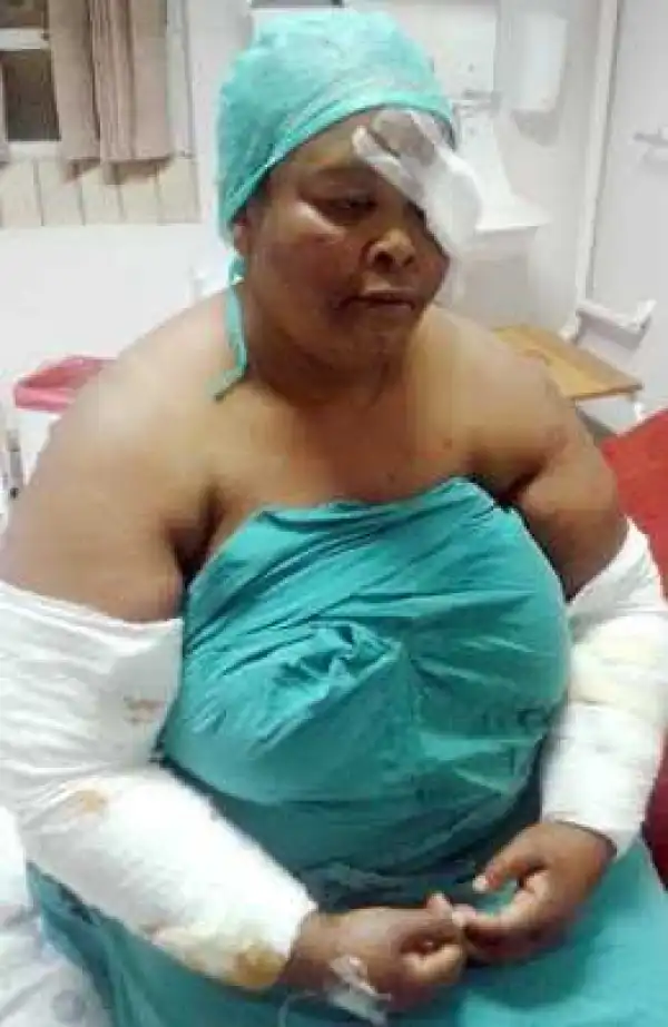 Woman Viciously Attacked By Her Pitbull Dogs. (Photo)